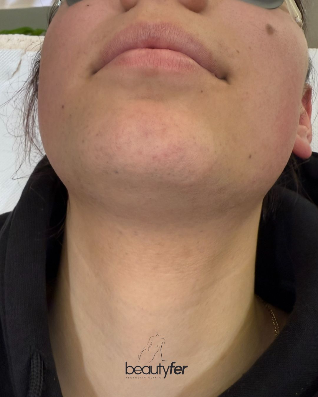Client after laser hair removal treatment