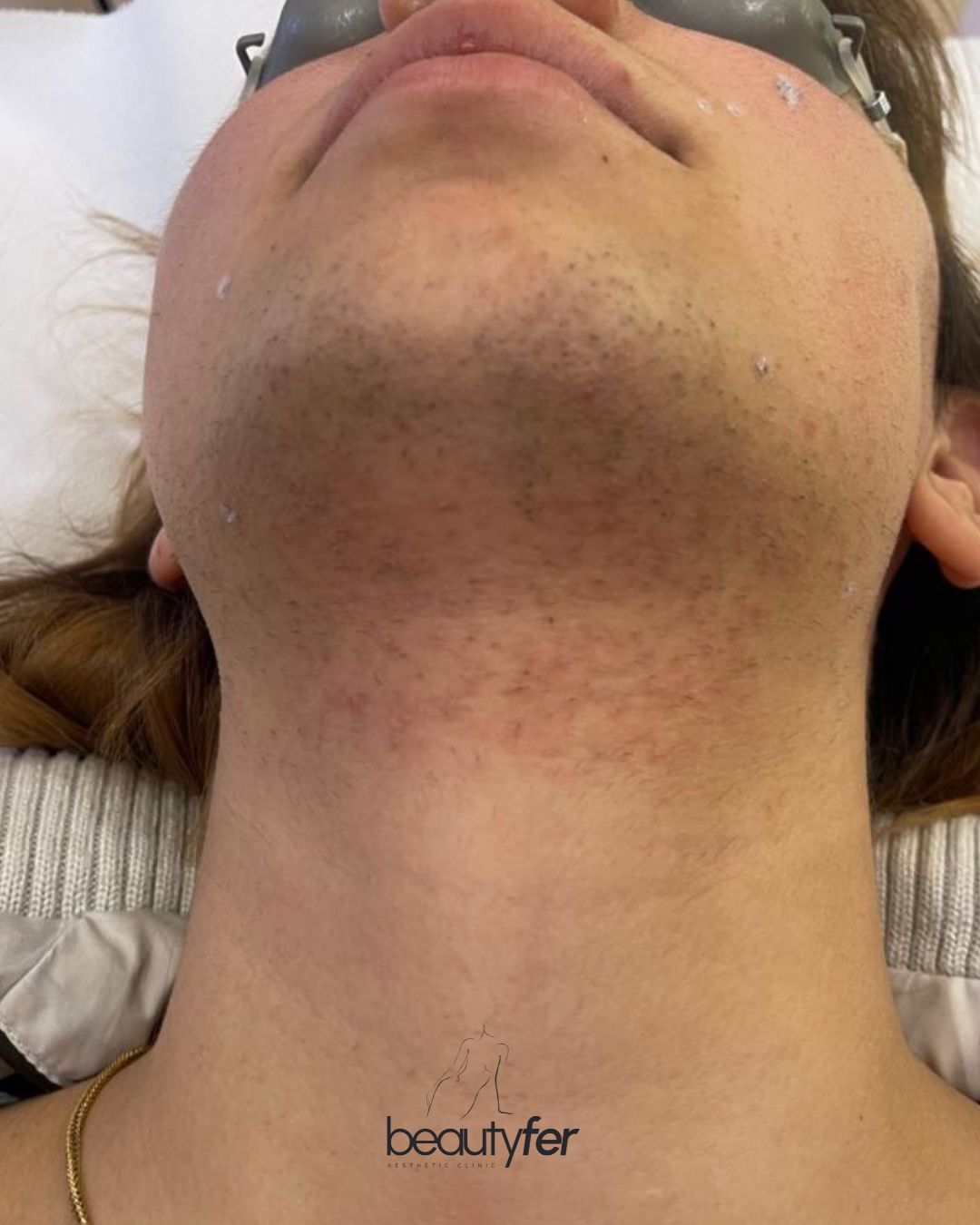 Client before laser hair removal treatment