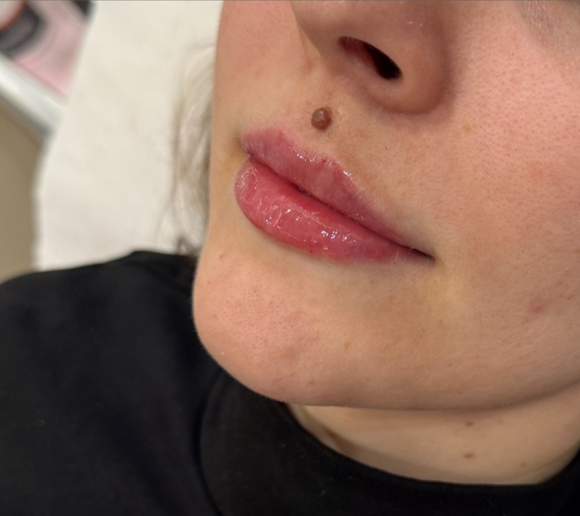 Client after lip filler treatment