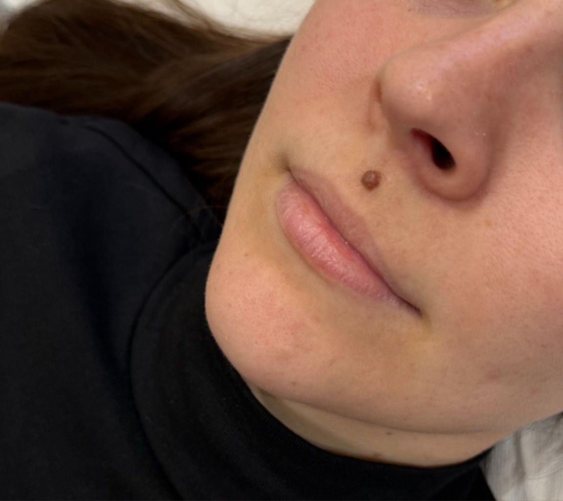Client before lip filler treatment