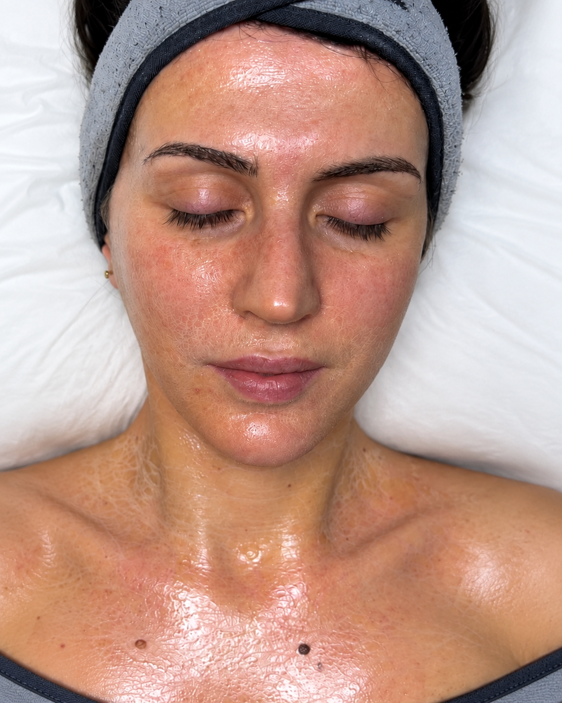 Client before Circadia Peptide Firming treatment