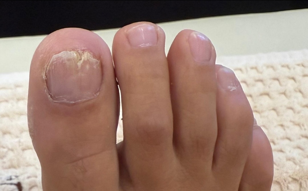 Client after toenail fungus treatment