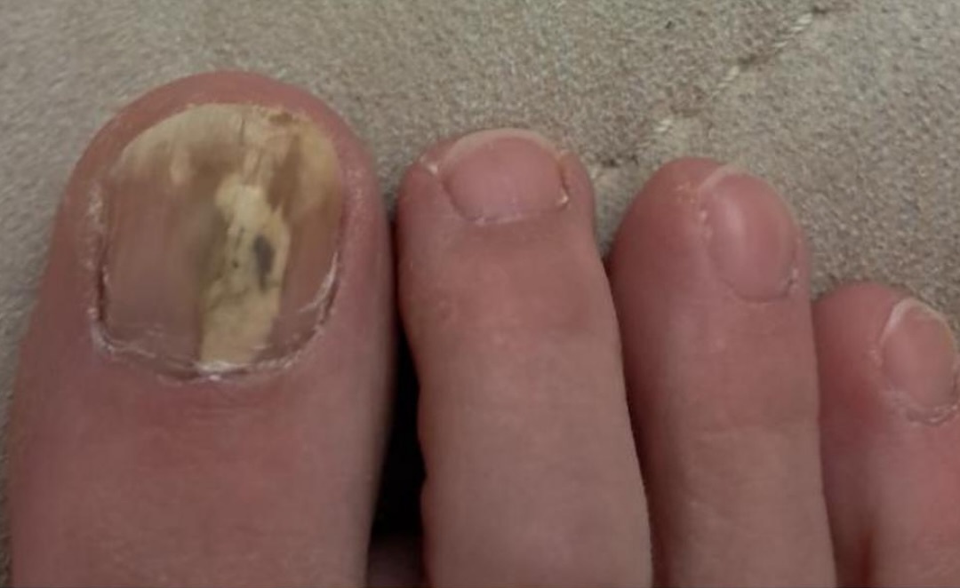 Client before toenail fungus treatment